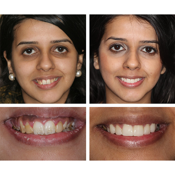 🔥Last Day 49% OFF Teeth Whitening Essence